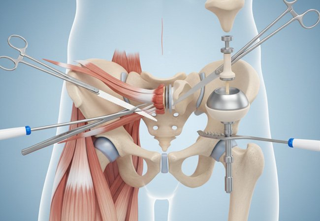 Hip replacement surgery